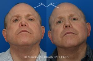 Photo of a patient before and after a procedure. One-Year Results of Saddle Nose Reconstruction Using Rib Cartilage Graft - One-year follow-up photos demonstrate the results of saddle nose reconstruction using the patient’s own rib cartilage. The patient had suffered a severe nasal injury that led to collapse of the nasal bridge, right nostril, and a large septal perforation. In the operating room, rib cartilage was harvested to reconstruct and support the nasal bridge and tip. A delicate graft was also placed to restore the structure of the collapsed right nostril.