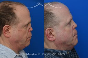 Photo of a patient before and after a procedure. One-Year Results of Saddle Nose Reconstruction Using Rib Cartilage Graft - One-year follow-up photos demonstrate the results of saddle nose reconstruction using the patient’s own rib cartilage. The patient had suffered a severe nasal injury that led to collapse of the nasal bridge, right nostril, and a large septal perforation. In the operating room, rib cartilage was harvested to reconstruct and support the nasal bridge and tip. A delicate graft was also placed to restore the structure of the collapsed right nostril.