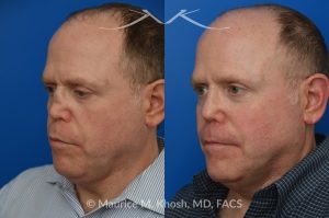 Photo of a patient before and after a procedure. One-Year Results of Saddle Nose Reconstruction Using Rib Cartilage Graft - One-year follow-up photos demonstrate the results of saddle nose reconstruction using the patient’s own rib cartilage. The patient had suffered a severe nasal injury that led to collapse of the nasal bridge, right nostril, and a large septal perforation. In the operating room, rib cartilage was harvested to reconstruct and support the nasal bridge and tip. A delicate graft was also placed to restore the structure of the collapsed right nostril.