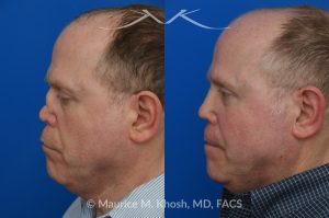 Photo of a patient before and after a procedure. One-Year Results of Saddle Nose Reconstruction Using Rib Cartilage Graft - One-year follow-up photos demonstrate the results of saddle nose reconstruction using the patient’s own rib cartilage. The patient had suffered a severe nasal injury that led to collapse of the nasal bridge, right nostril, and a large septal perforation. In the operating room, rib cartilage was harvested to reconstruct and support the nasal bridge and tip. A delicate graft was also placed to restore the structure of the collapsed right nostril.
