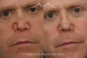 Photo of a patient before and after a procedure. One-Year Results of Saddle Nose Reconstruction Using Rib Cartilage Graft - One-year follow-up photos demonstrate the results of saddle nose reconstruction using the patient’s own rib cartilage. The patient had suffered a severe nasal injury that led to collapse of the nasal bridge, right nostril, and a large septal perforation. In the operating room, rib cartilage was harvested to reconstruct and support the nasal bridge and tip. A delicate graft was also placed to restore the structure of the collapsed right nostril.