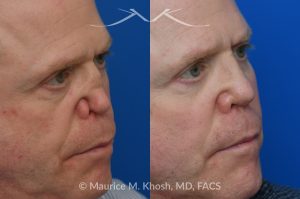 Photo of a patient before and after a procedure. One-Year Results of Saddle Nose Reconstruction Using Rib Cartilage Graft - One-year follow-up photos demonstrate the results of saddle nose reconstruction using the patient’s own rib cartilage. The patient had suffered a severe nasal injury that led to collapse of the nasal bridge, right nostril, and a large septal perforation. In the operating room, rib cartilage was harvested to reconstruct and support the nasal bridge and tip. A delicate graft was also placed to restore the structure of the collapsed right nostril.