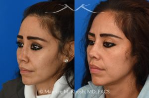 Photo of a patient before and after a procedure. Revision Saddle Nose Repair with Rib Cartilage and Fascia - This patient had previously undergone an unsuccessful rhinoplasty surgery with cadaver rib cartilage graft. She had developed a saddle collapse of her nose and loss of nasal tip definition. Her own rib and temporalis fascia was used to reconstruct the nose. She is ecstatic with her results at 6 months post op. 