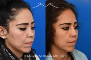 Photo of a patient before and after a procedure. Revision Saddle Nose Repair with Rib Cartilage and Fascia - This patient had previously undergone an unsuccessful rhinoplasty surgery with cadaver rib cartilage graft. She had developed a saddle collapse of her nose and loss of nasal tip definition. Her own rib and temporalis fascia was used to reconstruct the nose. She is ecstatic with her results at 6 months post op. 