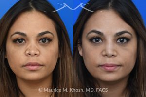 Photo of a patient before and after a procedure. Saddle Nose Repair with Rib Cartilage and Alloderm Graft - This lovely patient had developed saddle collapse of the nose, over-rotation of the nasal tip, and severe nasal obstruction, associated with a septum perforation. In the operating room, a segment of her rib was used to create cartilage grafts to augment the dorsum, and support the nasal tip. A shield graft was fashioned to enhance her nasal tip. Alloderm graft was applied above the dorsal cartilage graft, under the skin. Internal nasal scar tissue was released to further improve breathing. 