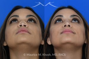 Photo of a patient before and after a procedure. Saddle Nose Repair with Rib Cartilage and Alloderm Graft - This lovely patient had developed saddle collapse of the nose, over-rotation of the nasal tip, and severe nasal obstruction, associated with a septum perforation. In the operating room, a segment of her rib was used to create cartilage grafts to augment the dorsum, and support the nasal tip. A shield graft was fashioned to enhance her nasal tip. Alloderm graft was applied above the dorsal cartilage graft, under the skin. Internal nasal scar tissue was released to further improve breathing. 