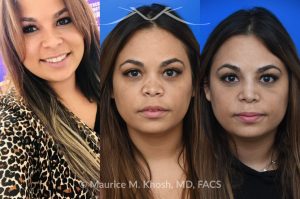 Photo of a patient before and after a procedure. Saddle Nose Repair with Rib Cartilage and Alloderm Graft - This lovely patient had developed saddle collapse of the nose, over-rotation of the nasal tip, and severe nasal obstruction, associated with a septum perforation. In the operating room, a segment of her rib was used to create cartilage grafts to augment the dorsum, and support the nasal tip. A shield graft was fashioned to enhance her nasal tip. Alloderm graft was applied above the dorsal cartilage graft, under the skin. Internal nasal scar tissue was released to further improve breathing. 