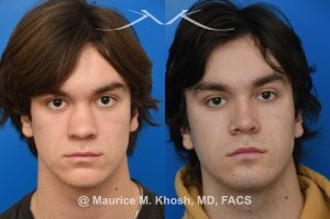 Photo of a patient before and after a procedure. Saddle Nose Repair with Rib Cartilage - Saddle nose collapse in this young patient was repaired with his own rib cartilage. Surgery not only improved his nasal deformity, it also enhanced his breathing capacity. 