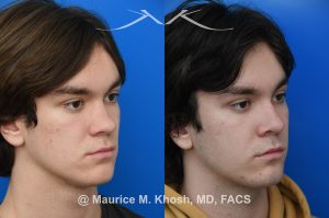 Photo of a patient before and after a procedure. Saddle Nose Repair with Rib Cartilage - Saddle nose collapse in this young patient was repaired with his own rib cartilage. Surgery not only improved his nasal deformity, it also enhanced his breathing capacity. 