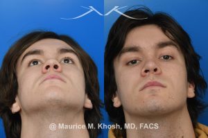 Photo of a patient before and after a procedure. Saddle Nose Repair with Rib Cartilage - Saddle nose collapse in this young patient was repaired with his own rib cartilage. Surgery not only improved his nasal deformity, it also enhanced his breathing capacity. 