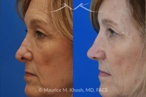 Photo of a patient before and after a procedure. Secondary Repair of Nostril Retraction After Mohs Surgery - This lovely 60 year-old had undergone repair of Mohs cancer removal from the left lower nose, by another surgeon. Unfortunately, this resulted in severe retraction of the left nostril and an unacceptable nasal deformity. 
Rhinoplasty to address nostril retraction was performed in Manhattan. Cartilage graft to the left nostril and composite graft (combination of skin and cartilage graft) to the inside edge of the nostril, helped to restore normality to the nose. The post op pictures are 6 months following her rhinoplasty.