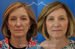 Photo of a patient before and after a procedure. Secondary Repair of Nostril Retraction After Mohs Surgery - This lovely 60 year-old had undergone repair of Mohs cancer removal from the left lower nose, by another surgeon. Unfortunately, this resulted in severe retraction of the left nostril and an unacceptable nasal deformity. 
Rhinoplasty to address nostril retraction was performed in Manhattan. Cartilage graft to the left nostril and composite graft (combination of skin and cartilage graft) to the inside edge of the nostril, helped to restore normality to the nose. The post op pictures are 6 months following her rhinoplasty.