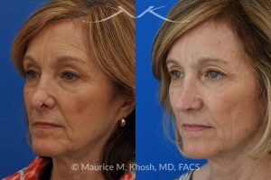 Photo of a patient before and after a procedure. Secondary Repair of Nostril Retraction After Mohs Surgery - This lovely 60 year-old had undergone repair of Mohs cancer removal from the left lower nose, by another surgeon. Unfortunately, this resulted in severe retraction of the left nostril and an unacceptable nasal deformity. 
Rhinoplasty to address nostril retraction was performed in Manhattan. Cartilage graft to the left nostril and composite graft (combination of skin and cartilage graft) to the inside edge of the nostril, helped to restore normality to the nose. The post op pictures are 6 months following her rhinoplasty.