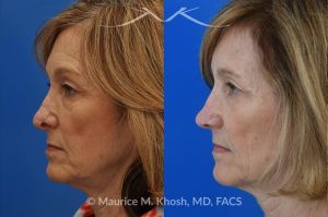 Photo of a patient before and after a procedure. Secondary Repair of Nostril Retraction After Mohs Surgery - This lovely 60 year-old had undergone repair of Mohs cancer removal from the left lower nose, by another surgeon. Unfortunately, this resulted in severe retraction of the left nostril and an unacceptable nasal deformity. 
Rhinoplasty to address nostril retraction was performed in Manhattan. Cartilage graft to the left nostril and composite graft (combination of skin and cartilage graft) to the inside edge of the nostril, helped to restore normality to the nose. The post op pictures are 6 months following her rhinoplasty.