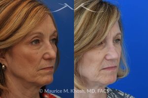 Photo of a patient before and after a procedure. Secondary Repair of Nostril Retraction After Mohs Surgery - This lovely 60 year-old had undergone repair of Mohs cancer removal from the left lower nose, by another surgeon. Unfortunately, this resulted in severe retraction of the left nostril and an unacceptable nasal deformity. 
Rhinoplasty to address nostril retraction was performed in Manhattan. Cartilage graft to the left nostril and composite graft (combination of skin and cartilage graft) to the inside edge of the nostril, helped to restore normality to the nose. The post op pictures are 6 months following her rhinoplasty.