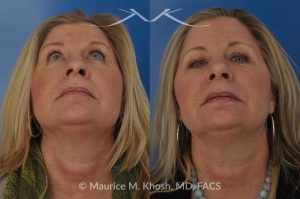 Photo of a patient before and after a procedure. Subtle Rhinoplasty to Correct Nasal Tip Deviation, Reduce Hump, and Refine the Nose - This subtle rhinoplasty procedure addresses the deviation of the nasal tip, reduces a nasal hump, and narrows and elevates the tip for a more balanced and refined appearance.


