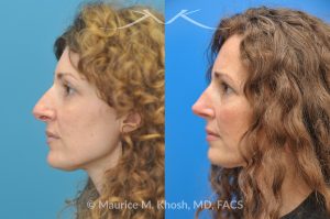 Photo of a patient before and after a procedure. Tip and Bridge Refinement - This young lady requested rhinoplasty to address dorsal hump, wide tip, and hanging columella. Surgery performed through the open rhinoplasty approach.