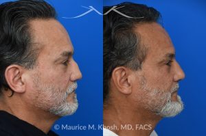 Photo of a patient before and after a procedure. Rib Cartilage Rhinoplasty with Dorsal Hump Reduction and Tip Refinement - Rhinoplasty Using Autologous Rib Cartilage to Correct High Dorsal Septal Deviation Following Unsuccessful Septoplasty, with Simultaneous Dorsal Hump Reduction and Nasal Tip Rotation.