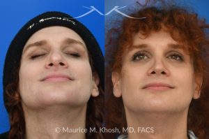 Photo of a patient before and after a procedure. Rhinoplasty to Reduce Nasal Hump and Refine the Tip - This rhinoplasty procedure focused on reducing a prominent nasal hump and refining the nasal tip to create a more balanced and harmonious profile. The result is a natural, proportionate enhancement of the nose.


