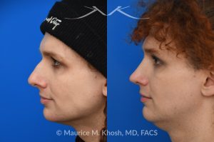 Photo of a patient before and after a procedure. Rhinoplasty to Reduce Nasal Hump and Refine the Tip - This rhinoplasty procedure focused on reducing a prominent nasal hump and refining the nasal tip to create a more balanced and harmonious profile. The result is a natural, proportionate enhancement of the nose.

