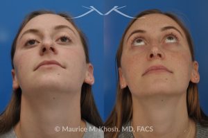 Photo of a patient before and after a procedure. Nose Job to Refine and Elevate Tip and Reduce a Hump - This 19 year old wanted rhinoplasty in New York City to address a droopy nasal tip, and a nasal hump. She disliked the movement of the tip of her nose when she smiled. She was treated with open rhinoplasty which allowed dorsal reduction, bilateral cartilage spreader grafts and alar rim grafts (to maintain breathing), and tip narrowing.