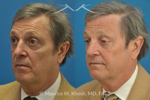 Photo of a patient before and after a procedure. Repair of Nasal Valve Stenosis - pre- and post-operative.