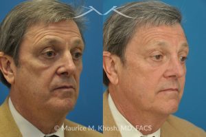 Photo of a patient before and after a procedure. Repair of Nasal Valve Stenosis - pre- and post-operative.
