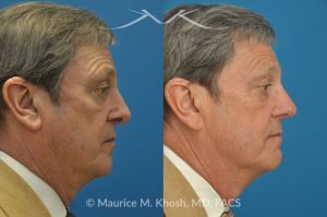 Photo of a patient before and after a procedure. Repair of Nasal Valve Stenosis - pre- and post-operative.