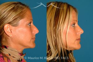 Photo of a patient before and after a procedure. Rhinoplasty for Tip & Dorsum - This patient was interested in addressing the hump on her nose and reducing the columellar show (hanging columella). Surgery was performed via the closed rhinoplasty approach.