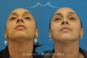 Photo of a patient before and after a procedure. Rhinoplasty to Remove Nasal Hump - This young lady with Hispanic ethnicity was interested in removing a small hump in the nose. Rhinoplasty was performed through a closed (endonasal) approach.