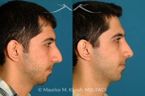 Photo of a patient before and after a procedure. Rhinoplasty and Chin Implant - before-and-after composite photo.