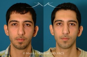 Photo of a patient before and after a procedure. Rhinoplasty and Chin Implant - before-and-after composite photo.