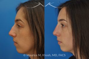 Photo of a patient before and after a procedure. Rhinoplasty to Remove Hump and Improve Breathing - This young lady in her twenties co breathing difficulty and a nasal bony hump. She underwent rhinoplasty through an endo-nasal or closed approach. He nasal hump was removed. She also had cartilage grafts (right sided spreader graft and bilateral alar strut grafts) to support her nasal valve patency.