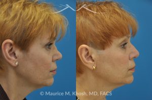 Photo of a patient before and after a procedure. Saddle Nose - before-and-after composite photo.