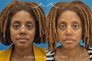 Photo of a patient before and after a procedure. Saddle Nose - before-and-after composite photo.