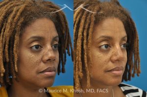 Photo of a patient before and after a procedure. Saddle Nose - before-and-after composite photo.