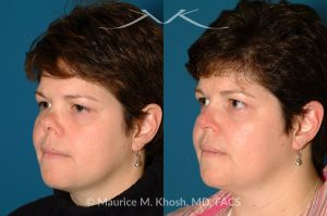 Photo of a patient before and after a procedure. Saddle Nose - before-and-after composite photo.