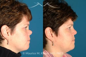 Photo of a patient before and after a procedure. Saddle Nose - before-and-after composite photo.