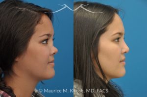 Photo of a patient before and after a procedure. Saddle Nose - before-and-after composite photo.
