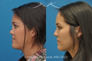 Photo of a patient before and after a procedure. Saddle Nose - before-and-after composite photo.