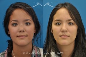 Photo of a patient before and after a procedure. Saddle Nose - before-and-after composite photo.
