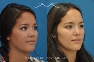 Photo of a patient before and after a procedure. Saddle Nose - before-and-after composite photo.