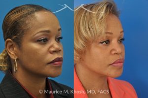 Photo of a patient before and after a procedure. Saddle Nose - before-and-after composite photo.