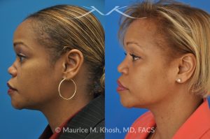 Photo of a patient before and after a procedure. Saddle Nose - before-and-after composite photo.