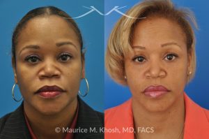 Photo of a patient before and after a procedure. Saddle Nose - before-and-after composite photo.