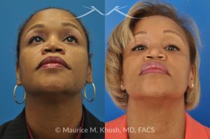 Photo of a patient before and after a procedure. Saddle Nose - before-and-after composite photo.