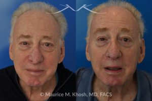 Photo of a patient before and after a procedure. Revision Rhinoplasty with Nasal Vestibular Stenosis Repair - This 73 year old had previously undergone rhinoplasty in his 20's. The surgery had left his nose deformed and severely obstructed. Revision rhinoplasty and repair of nasal vestibular stenosis was accomplished with use of cadaver rib cartilage. Revision surgery helped to restore a natural shape to the nose, and alleviate his breathing issues. He is delighted with the surgical results.