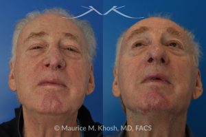 Photo of a patient before and after a procedure. Revision Rhinoplasty with Nasal Vestibular Stenosis Repair - This 73 year old had previously undergone rhinoplasty in his 20's. The surgery had left his nose deformed and severely obstructed. Revision rhinoplasty and repair of nasal vestibular stenosis was accomplished with use of cadaver rib cartilage. Revision surgery helped to restore a natural shape to the nose, and alleviate his breathing issues. He is delighted with the surgical results.