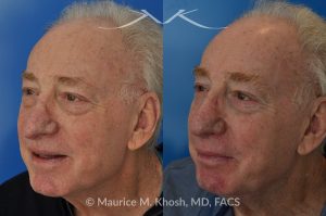 Photo of a patient before and after a procedure. Revision Rhinoplasty with Nasal Vestibular Stenosis Repair - This 73 year old had previously undergone rhinoplasty in his 20's. The surgery had left his nose deformed and severely obstructed. Revision rhinoplasty and repair of nasal vestibular stenosis was accomplished with use of cadaver rib cartilage. Revision surgery helped to restore a natural shape to the nose, and alleviate his breathing issues. He is delighted with the surgical results.
