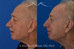 Photo of a patient before and after a procedure. Revision Rhinoplasty with Nasal Vestibular Stenosis Repair - This 73 year old had previously undergone rhinoplasty in his 20's. The surgery had left his nose deformed and severely obstructed. Revision rhinoplasty and repair of nasal vestibular stenosis was accomplished with use of cadaver rib cartilage. Revision surgery helped to restore a natural shape to the nose, and alleviate his breathing issues. He is delighted with the surgical results.